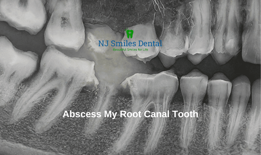 Featured image for “Is There An Abscess Below My Root Canal Tooth?”