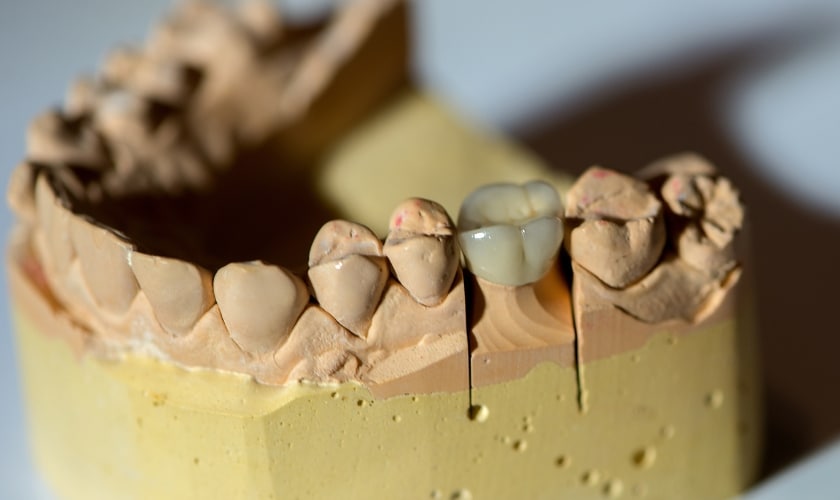 Featured image for “Tips On How To Take Care Of A New Dental Crown”