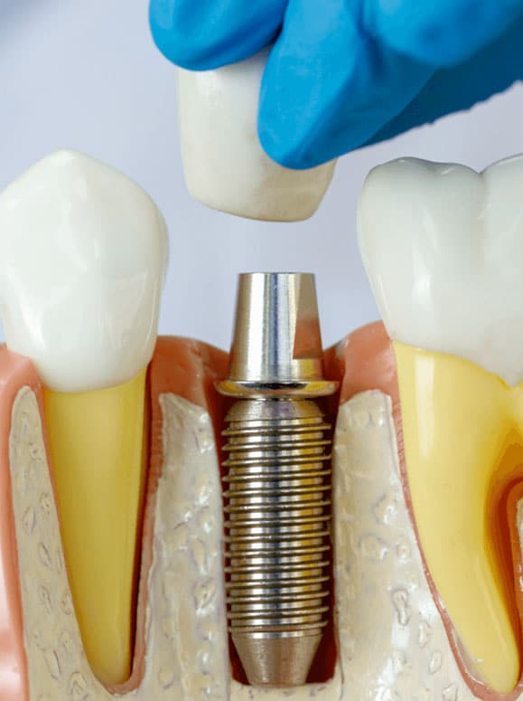 dental implant - nj smiles dental