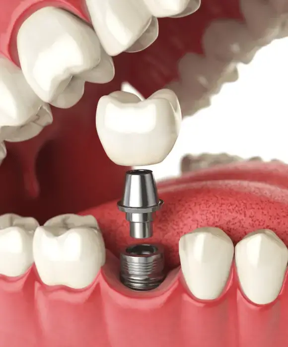 Dental Implants Union by NJ Smiles Dental